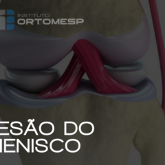 O que é lesão do menisco e como isso pode influenciar a vida de um atleta